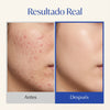Crema Facial  Para el Acné